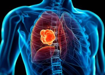 Revelan cáncer de pulmón es el que causa más muertes a nivel mundial