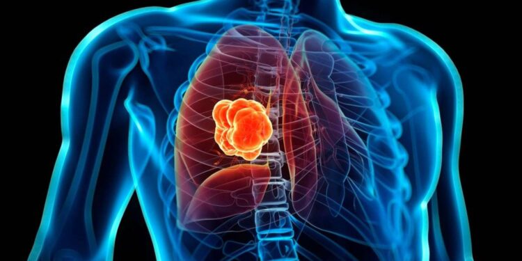 Revelan cáncer de pulmón es el que causa más muertes a nivel mundial