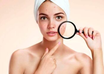 Acné: cómo evitarlo