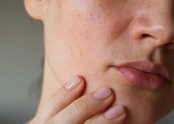 Piel grasa: las dudas más frecuentes