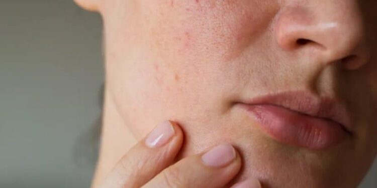 Piel grasa: las dudas más frecuentes